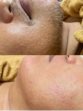 オフオルファヴォリ(OF Olu:Favori)/【フラッシュワックス脱毛】