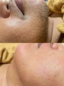 オフオルファヴォリ(OF Olu:Favori)/【フラッシュワックス脱毛】