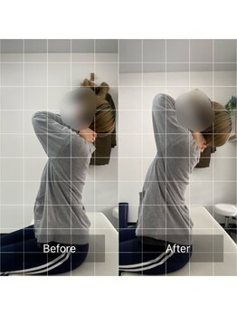 ナオル整体 池袋院(NAORU整体)/猫背の矯正の施術前後