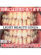 ライトビューティー 銀座店(LightBeauty)/東銀座 ホワイトニング症例写真