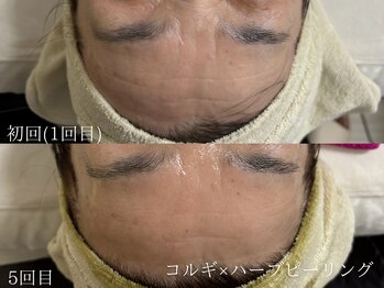 セレソル(CERESOL)/額のしわも改善◎(5回目の効果)