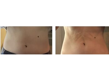 小顔アンドエイジングケア専門店 ビゼ(美sser)/REVIスカルプト20回