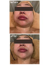 ラディアント(Radiant)/インディバ×レモンボトル