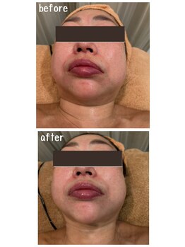 ラディアント(Radiant)/インディバ×レモンボトル