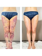 術後の女神 大阪本町店/ダウンタイムケア・インディバ