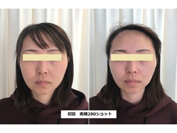 ナチュレアンドメディカ(Nature&Medica)/【たるみor小顔】ソフウェーブLT
