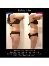 ヴェリー(VARY)/施術10回（１週間に１回）ヒップ