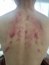 アノン(Anon)/中国式かっさ