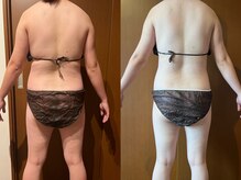 サラン鍼灸院(SARAN都楽鍼灸院)/よもぎ蒸し×エンダモロジー結果