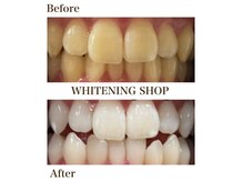 ホワイトニングショップ 尾道店(WHITENING SHOP)の雰囲気（ホワイトニング後、Before→After♪）