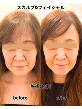 リプレサ バイ エステマニア(Ripresa)/ビフォーアフター