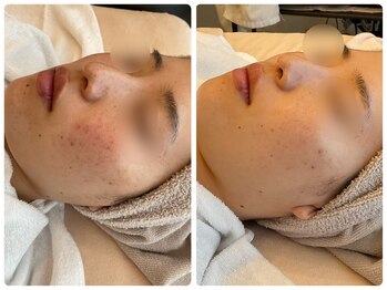 クラージュ/フォトフラクショナル2回施術