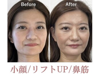 ラプリシュシュ 岡山店(Raplit)/ 隆鼻+輪郭矯正40分10回