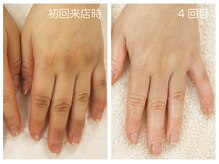 キレイテ 福岡天神店/40代/4回目【天神ハンドケア】