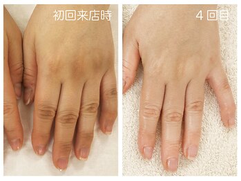 キレイテ 福岡天神店/40代/4回目【天神ハンドケア】