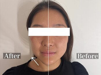 ラナ(Lana)の写真/【一度で変わる】たるみ・フェイスライン改善◎即実感の筋膜リフト！デコルテリンパ・ヘッドまで贅沢ケア