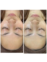 リセリュールサロン 東戸塚(RE:cellulesalon)/ハーブピーリングでくすみ改善