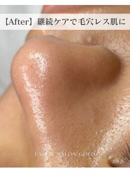 ゴールド 栄店(GOLD)/【After】毛穴レス肌に○*。.