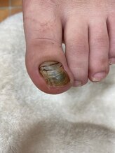 フットメンテ 巻き爪矯正センター 南浦和/鉤状の肥厚爪