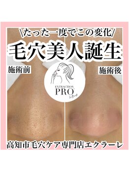 エクラーレ(Eclale)/【毛穴ケア】症例