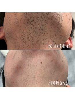 バルダー 原宿 神宮前(BALDER.)/メンズ(髭)脱毛