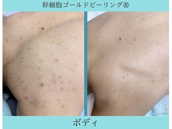 リメイククリニカルビューティー(Remake clinical beauty)/薄着の季節に向けて