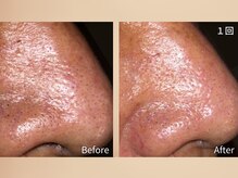 あすはれ/ハイドロヴィーナス毛穴洗浄