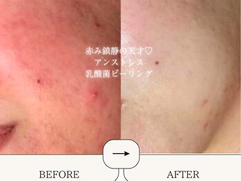 ハイフン(HIFUN)/クリスティーナ毛穴ニキビケア