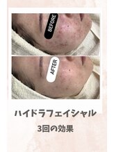 リンフェイス 浦安店(RINFACE)/大人気ハイドラ×乳歯幹細胞導入