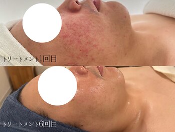 クリアヒーリングサロン/２０代男性毛穴色むらケア