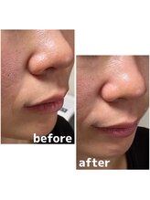 エリシオン(ELYSION)/ハイドラフェイシャル