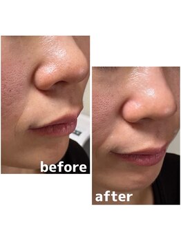 エリシオン(ELYSION)/ハイドラフェイシャル