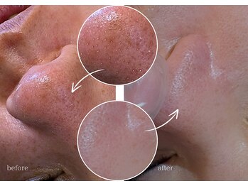 プアマヌ(PUA MANU)/イチゴ鼻/毛穴ケア/角質ケア