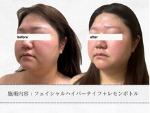 エメ 名古屋栄店(aimer)/レモンボトル<小顔・脂肪分解>