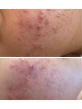 CPサロン フェリーチェ/3回目お手入れビフォーアフター