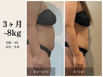 サロン ルイス アディクト(salon Lewis Addict)/脂肪冷却