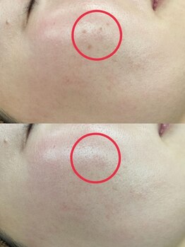 リンド(lindo)/シミケア 1回施術 30代女性