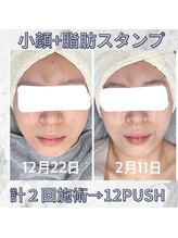 ハロ 南青山(HALO)/小顔Vリフト+スタンプ痩身計２回