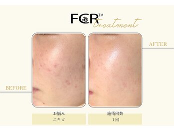 ハーバル 新宿店(HERBAL)/最強★韓国FCRハーブピーリング