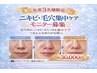 【ニキビ・毛穴集中ケア5回コース】原液美容液導入モニター募集！