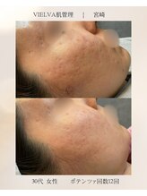 ヴィエルバ(VIELVA)/お肌の凹凸・跡