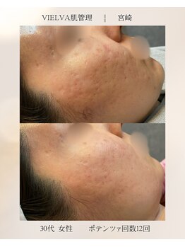 ヴィエルバ(VIELVA)/お肌の凹凸・跡
