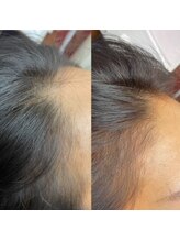 トータルビューティーサロン キララ(KIRARA)/最先端・育毛促進メニュー