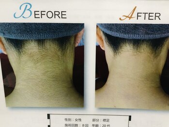 ビビ(BIBI)/ビフォーアフター