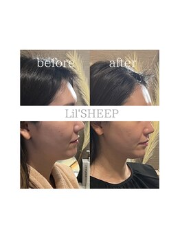 リルシープ(LIL'SHEEP)/眠れる小顔コルギ1回施術