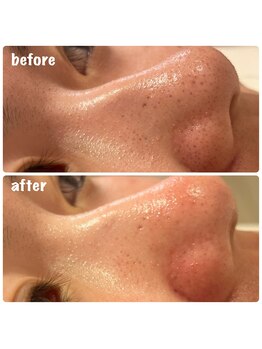 ハレハダ(HAREHADA)/毛穴洗浄◆ハイドラフェイシャル