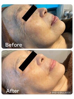 カーロ(CARO)/光フェイシャル