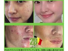 アレビュー(Arebeau)の雰囲気（ハーブピーリング2Bで短期で素肌美人に★当日と翌日はメイク不可）