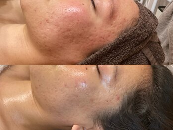 ビジュープラス 広島店(Bijou+)/【20代/凹凸肌、赤み】