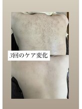 スキンプローズ(skinprose)/背中ハーブピーリング・ハード